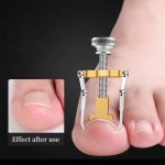 ابزار ارتودنسی ناخن